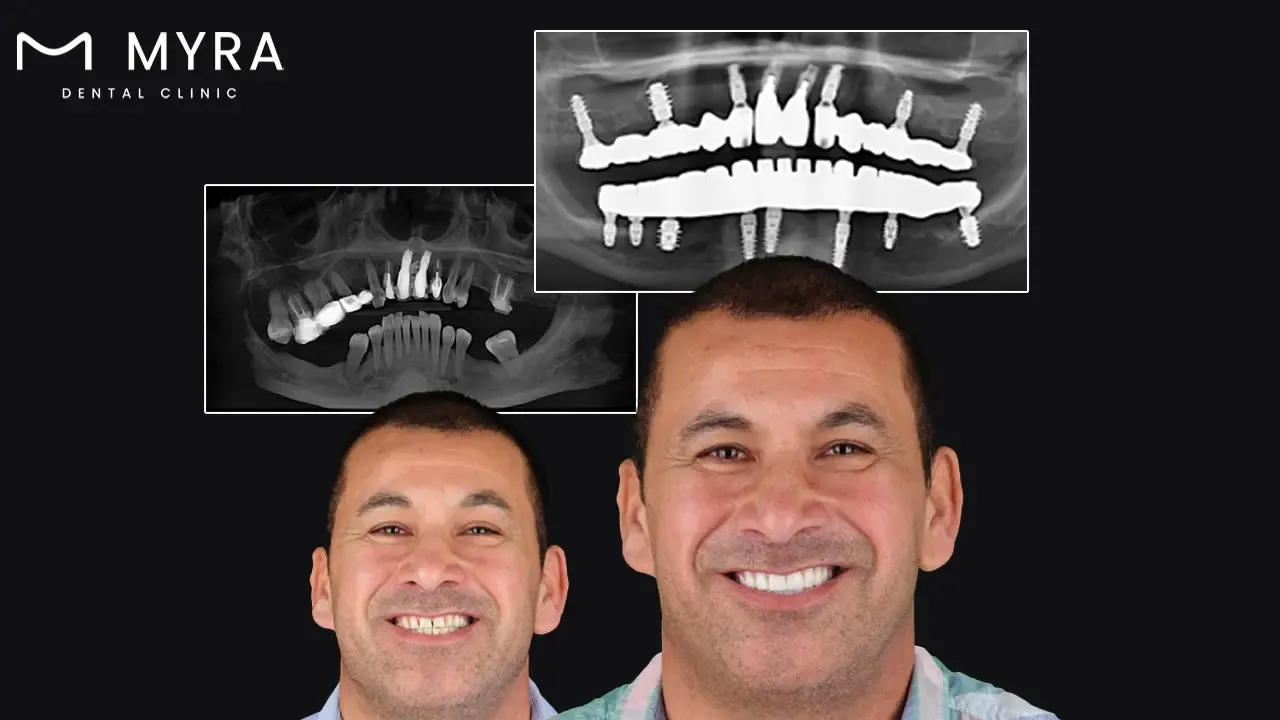 _Implants are Natural Looking.webp